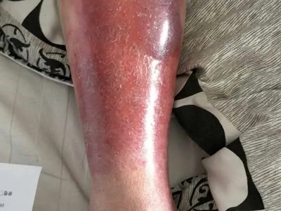 急性网状淋巴管炎的症状和图片 - 有来医生