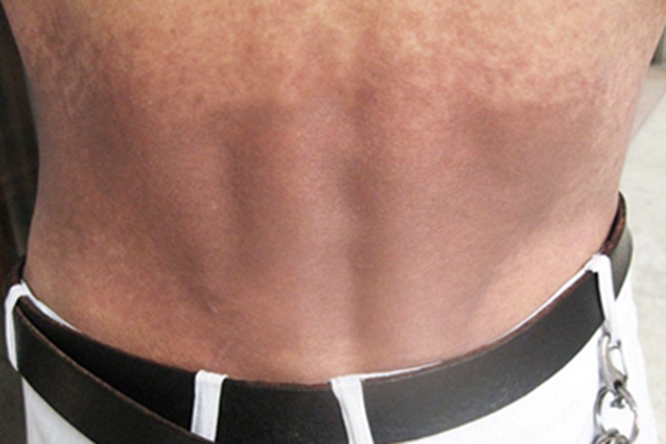 皮肤黑变病腰部有大片黑斑图