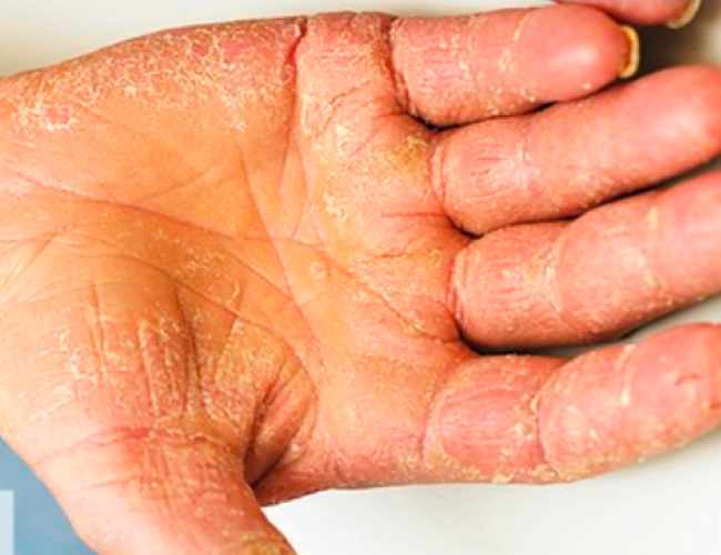 副肿瘤性肢端角化症手指脱皮图 副肿瘤性肢端角化症手指脱皮图