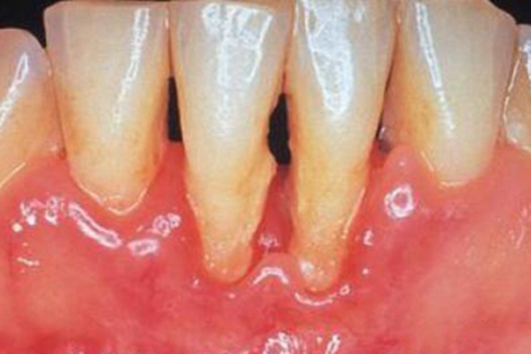 牙龈萎缩牙龈红肿牙齿细长图
