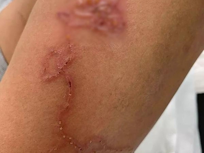 匐行疹胳膊上出现红色线条并结痂图