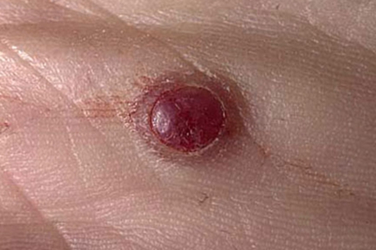 化脓性肉芽肿大包图