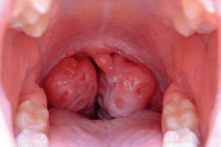 舌扁桃体肥大图 舌扁桃体肥大图