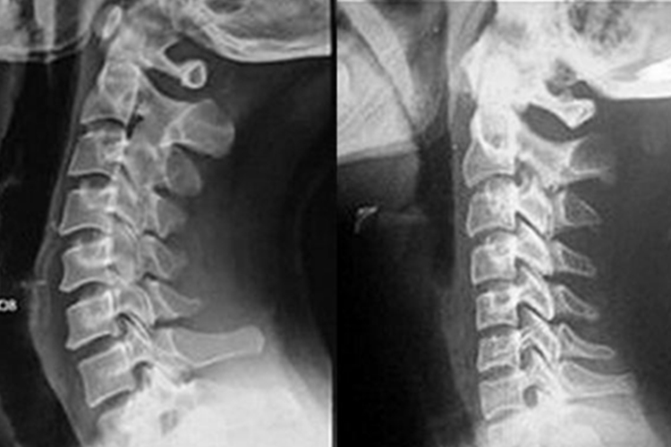 颈椎生理曲度变直X线图
