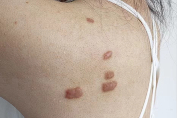 瘢痕疙瘩背部瘢痕图 瘢痕疙瘩背部瘢痕图