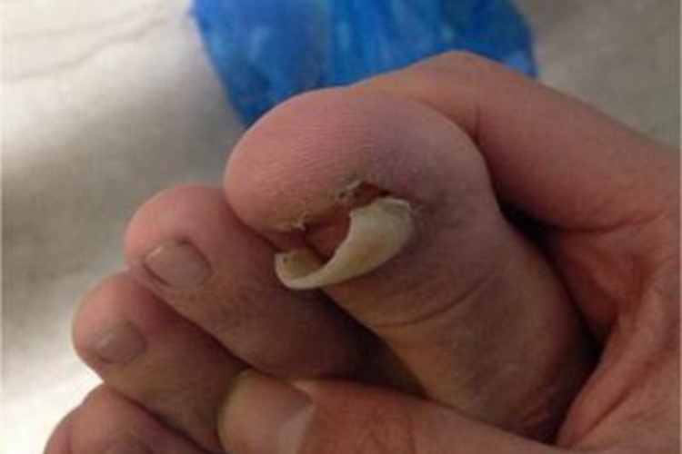 急性化脓性甲沟炎脚趾甲缺损图