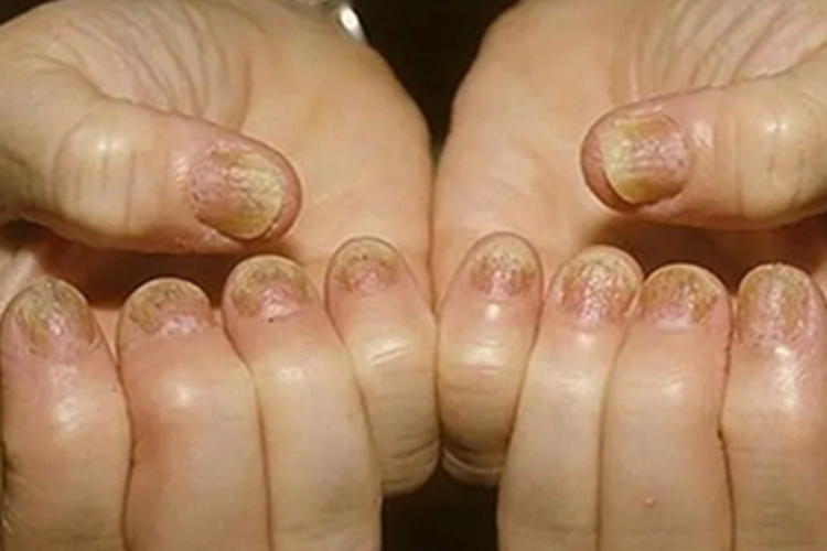 甲凹点指甲发黄有凹坑图 甲凹点指甲发黄有凹坑图