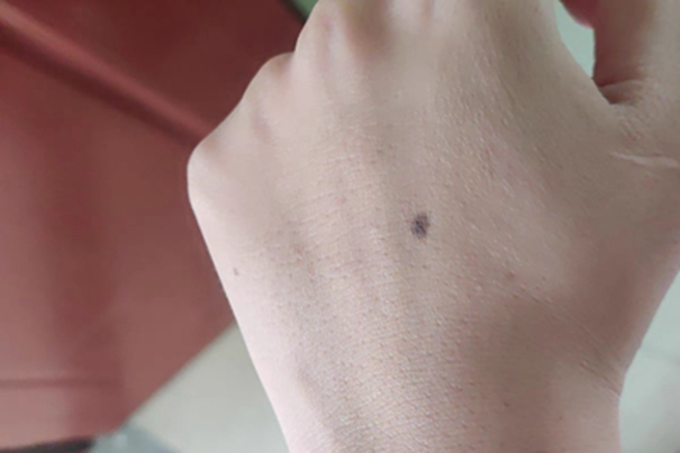 交界痣手背长黑色的斑图