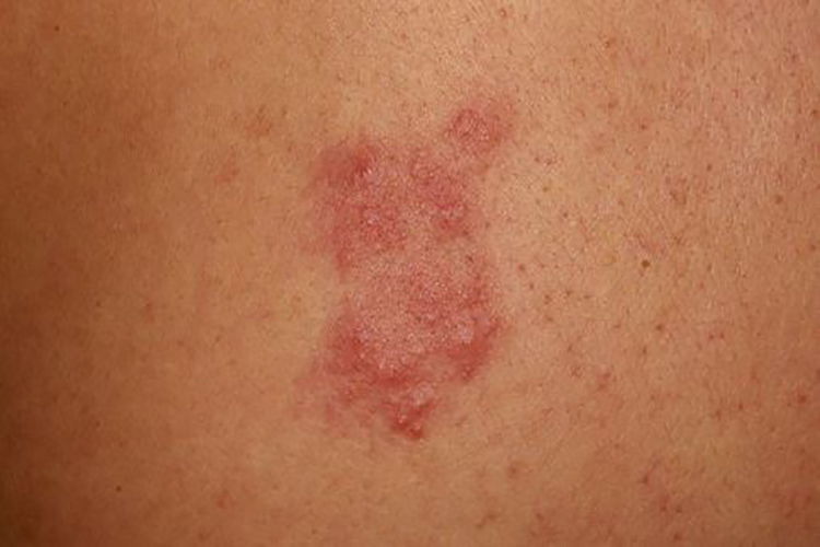 刺毛虫皮炎红色斑丘疹图