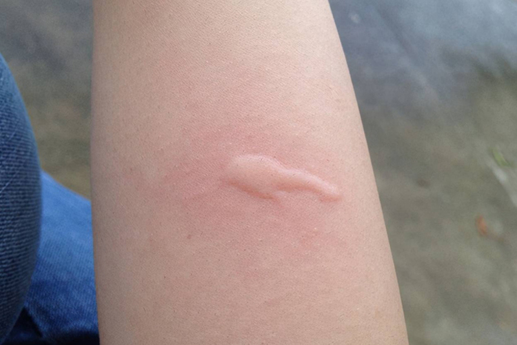 蚊虫叮咬胳膊风团图