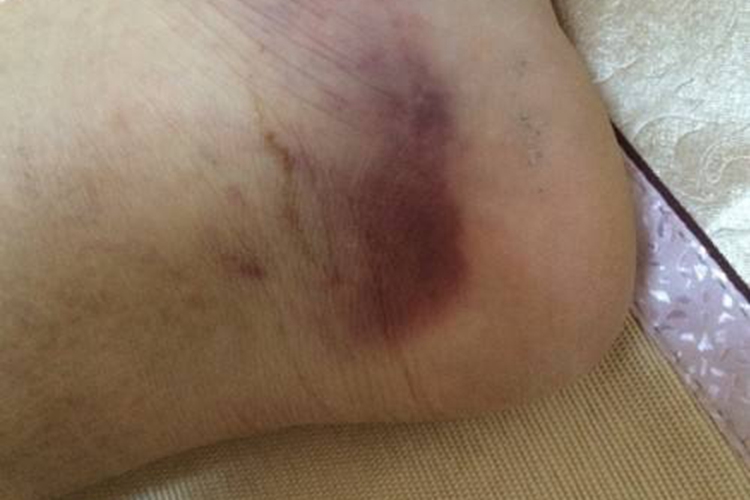 外伤后脚踝处发紫图