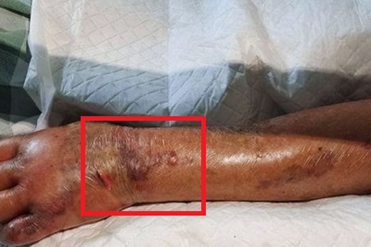 皮肤非典型分枝杆菌病手腕症状图 皮肤非典型分枝杆菌病手腕症状图