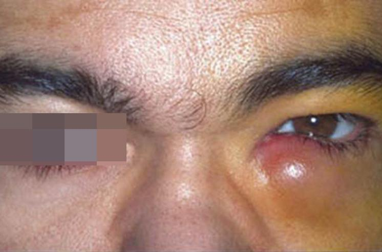 急性泪囊炎囊肿图 急性泪囊炎囊肿图