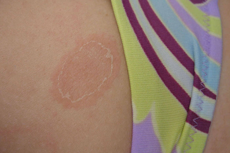 玫瑰糠疹环形皮疹图