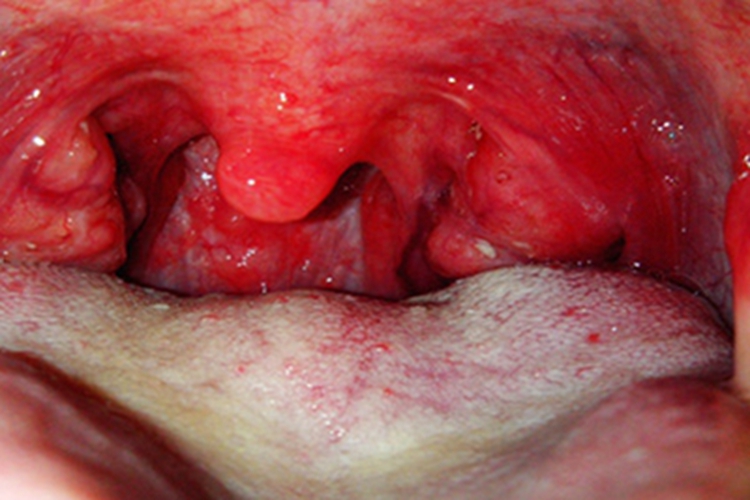 急性化脓性扁桃体炎嗓子红肿图