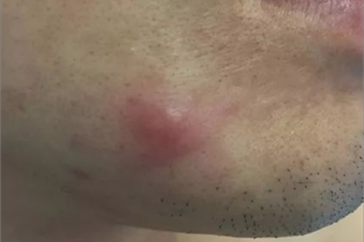 急性发热性嗜中性皮病大红疙瘩图 急性发热性嗜中性皮病大红疙瘩图