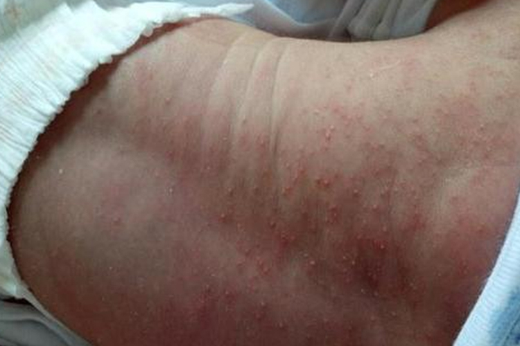 宝宝后背脓疱性栗粒疹图