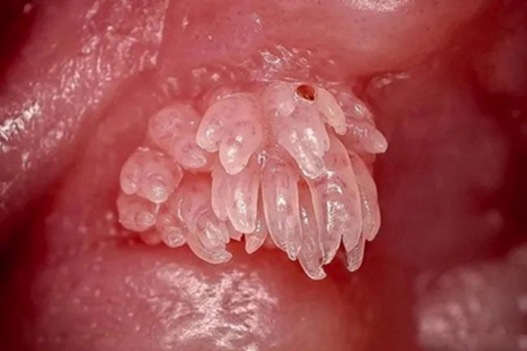 外耳道乳头状瘤外耳道症状图