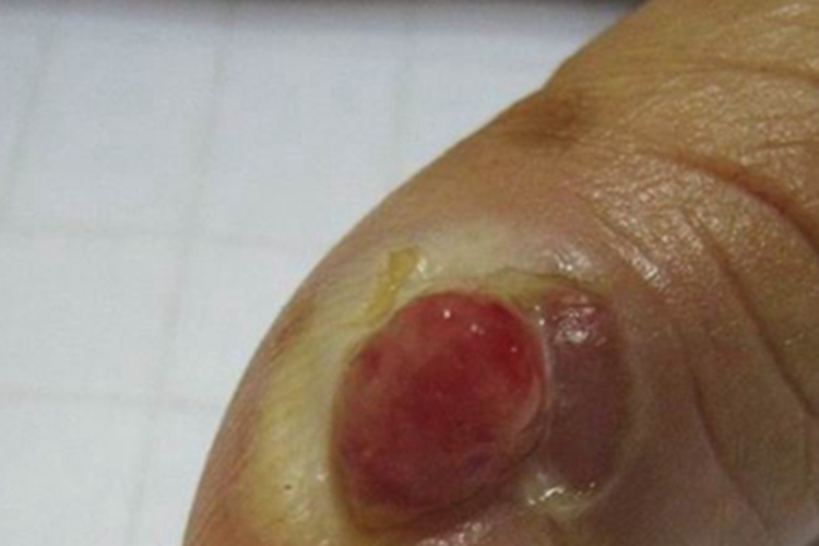 肉芽肿型血管瘤手指头长肉球图