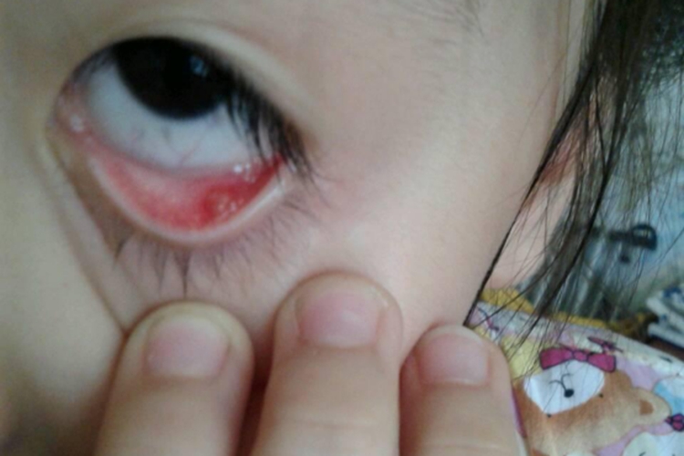 宝宝睑腺炎图
