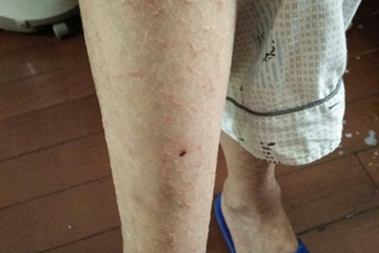 血管萎缩性皮肤异色病小腿红斑图 血管萎缩性皮肤异色病小腿红斑图
