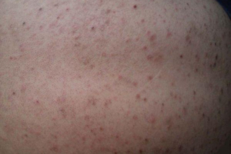 痘疮样型副银屑病症状图 痘疮样型副银屑病症状图
