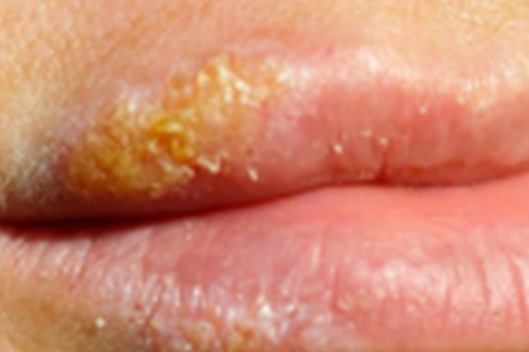 水疱干涸图 水疱干涸图