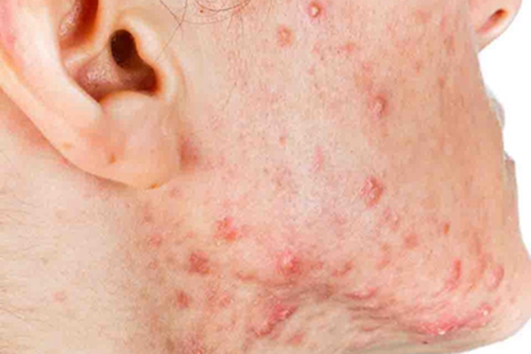 痤疮面部大红疙瘩图