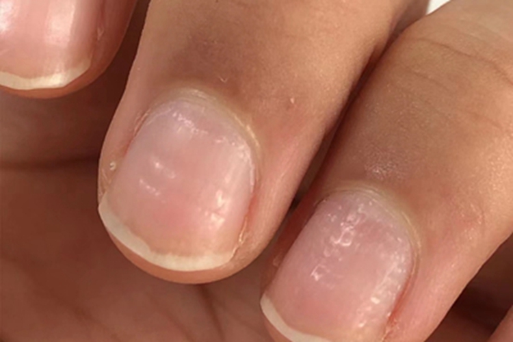 甲凹点指甲图 甲凹点指甲图