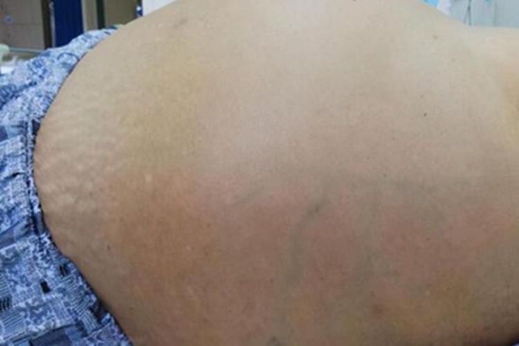 棘球蚴病肚子很鼓图