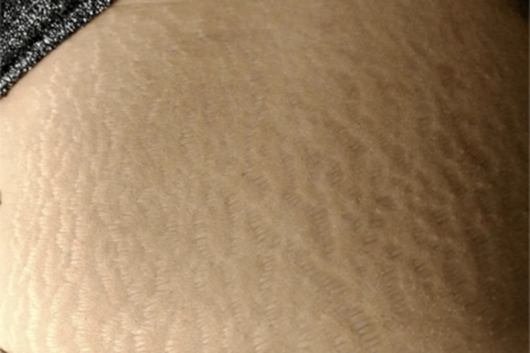 萎缩纹腰上有好多竖条纹图