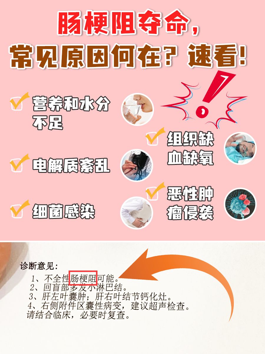 肠梗阻夺命，常见原因何在？速看！