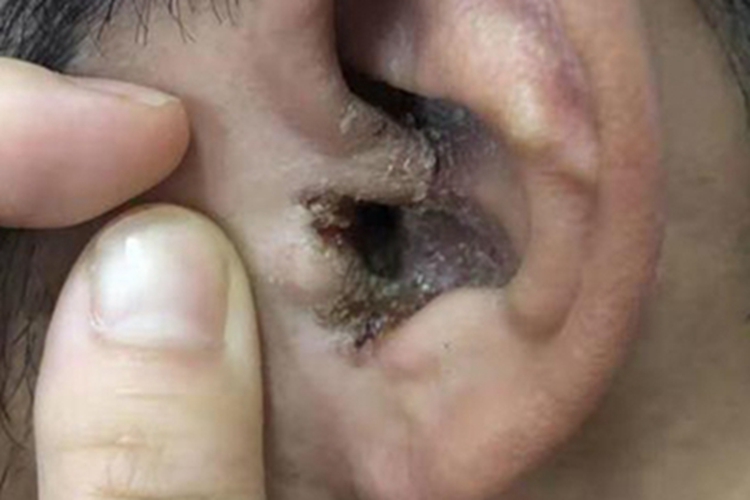 外耳湿疹耳部脱屑图