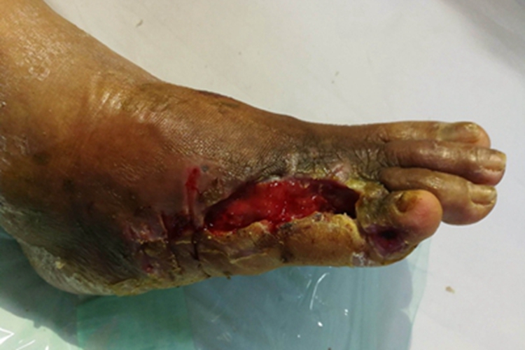 Ⅴ级糖尿病足症状图