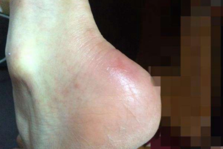 浸渍足脚后跟又红又肿图