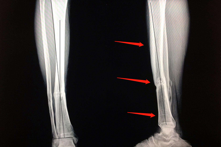 胫骨骨折畸形愈合图 胫骨骨折畸形愈合图