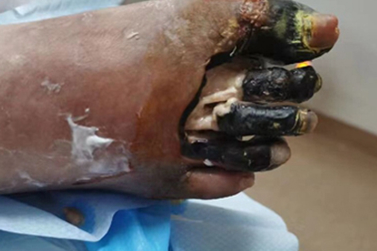 湿性坏疽脚趾皮肤发黑图 湿性坏疽脚趾皮肤发黑图