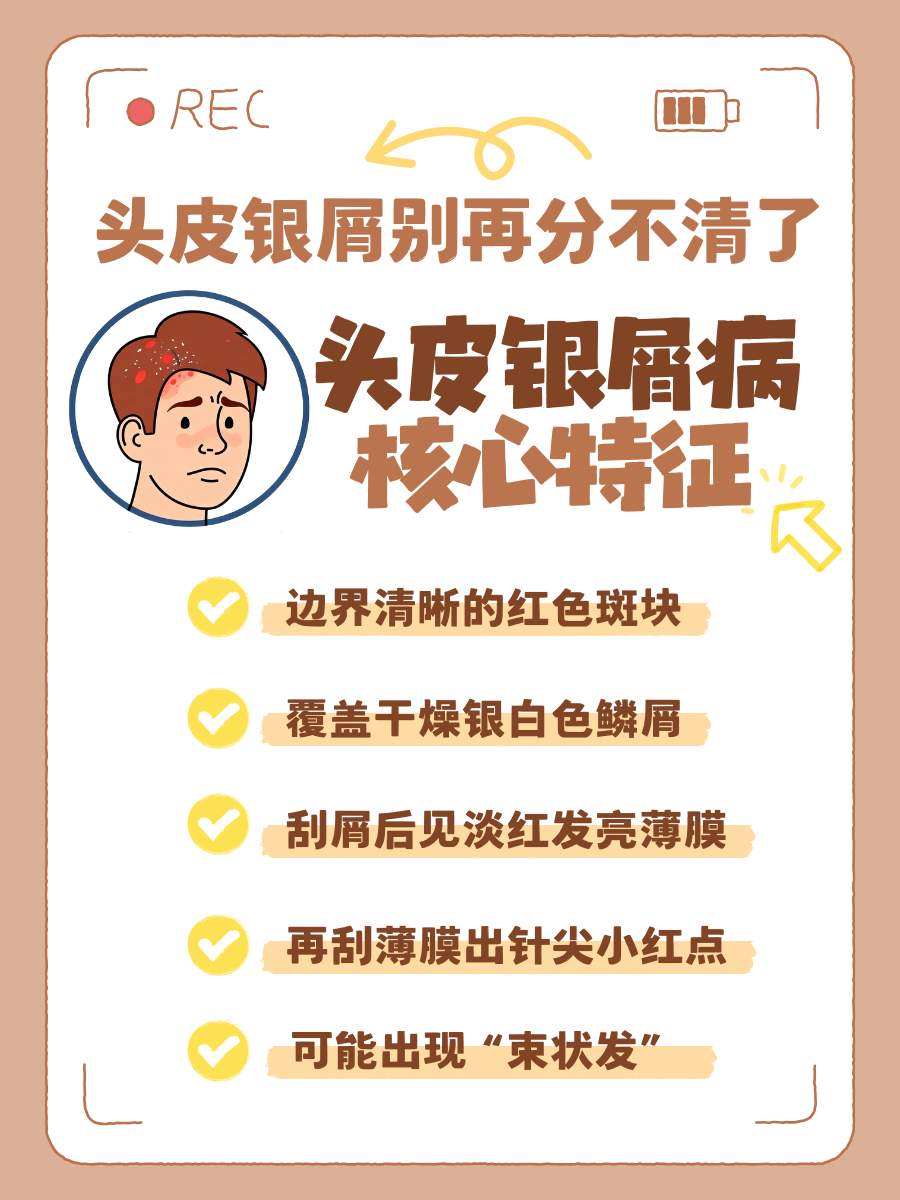 头皮银屑病图片|别把头屑当小事！