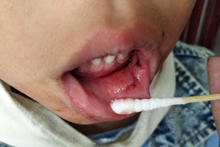 跌伤下嘴唇内出血图