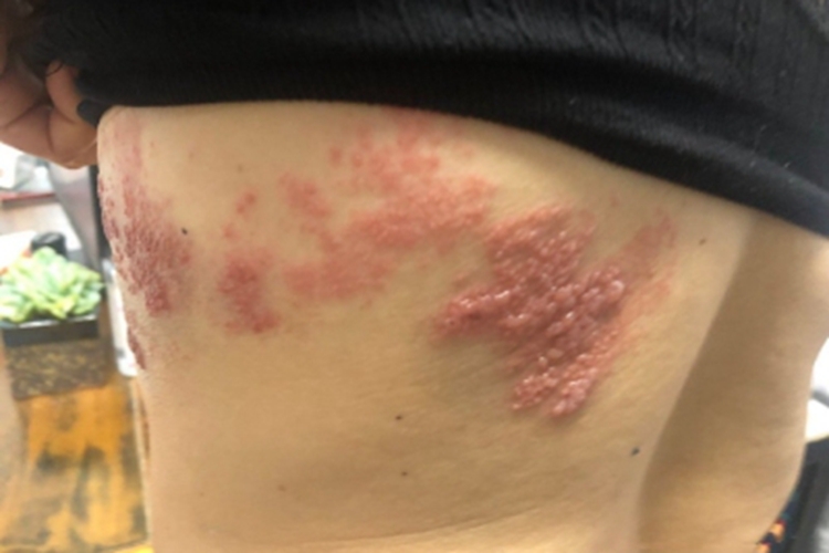 艾滋病感染性皮肤损害背部症状图