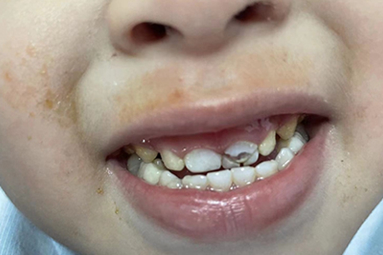 牙外伤牙齿缺损图