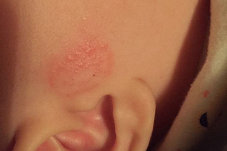 渗出型婴儿湿疹耳前红斑图