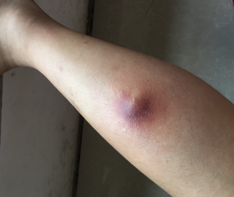 腿部皮脂腺囊肿图