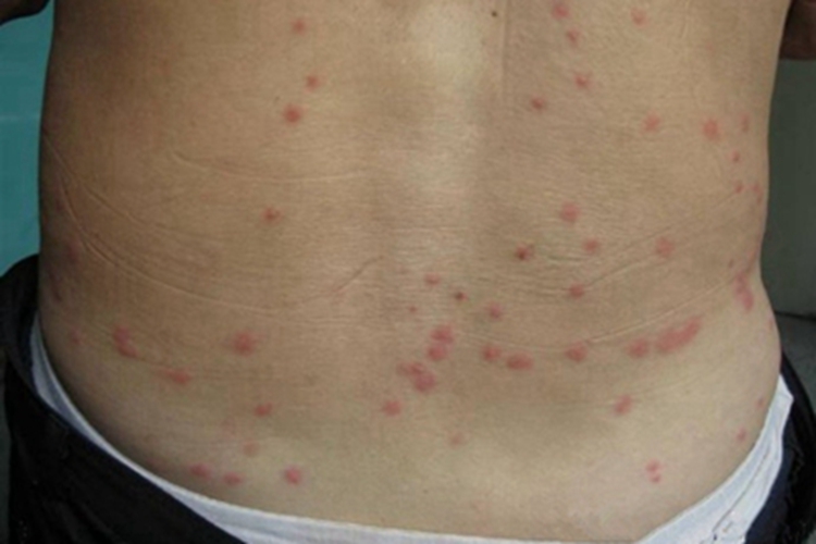 螨虫皮炎背部红斑图