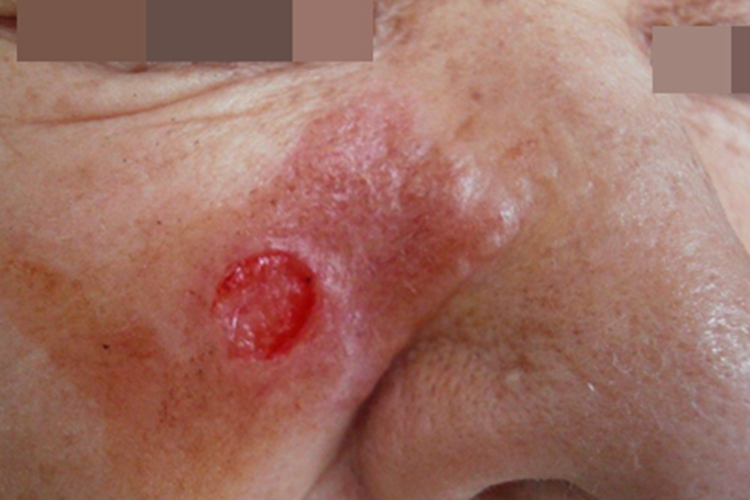 瘰疬性皮肤结核面部结节图 瘰疬性皮肤结核面部结节图