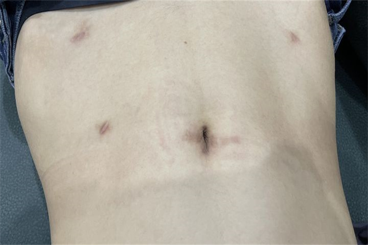 宫外孕腹腔镜手术疤痕图 宫外孕腹腔镜手术疤痕图