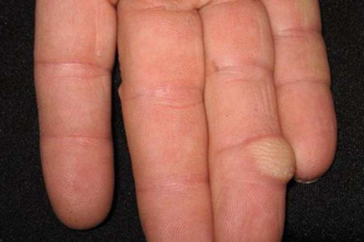 腱鞘巨细胞瘤手指硬疙瘩图