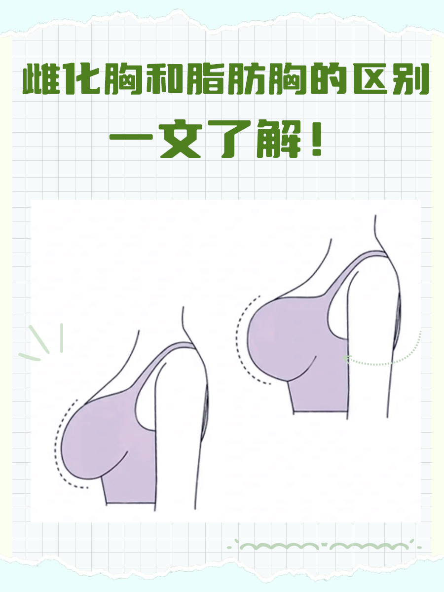雌化胸和脂肪胸的区别，一文了解！