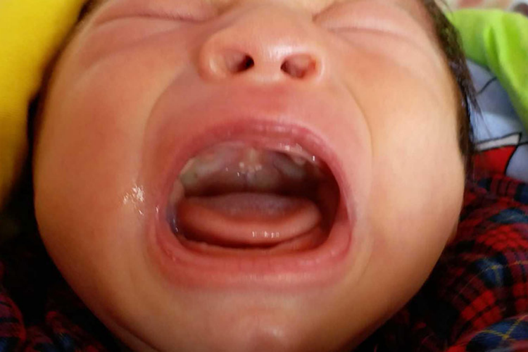 宝宝鹅口疮口腔黏膜潮红图