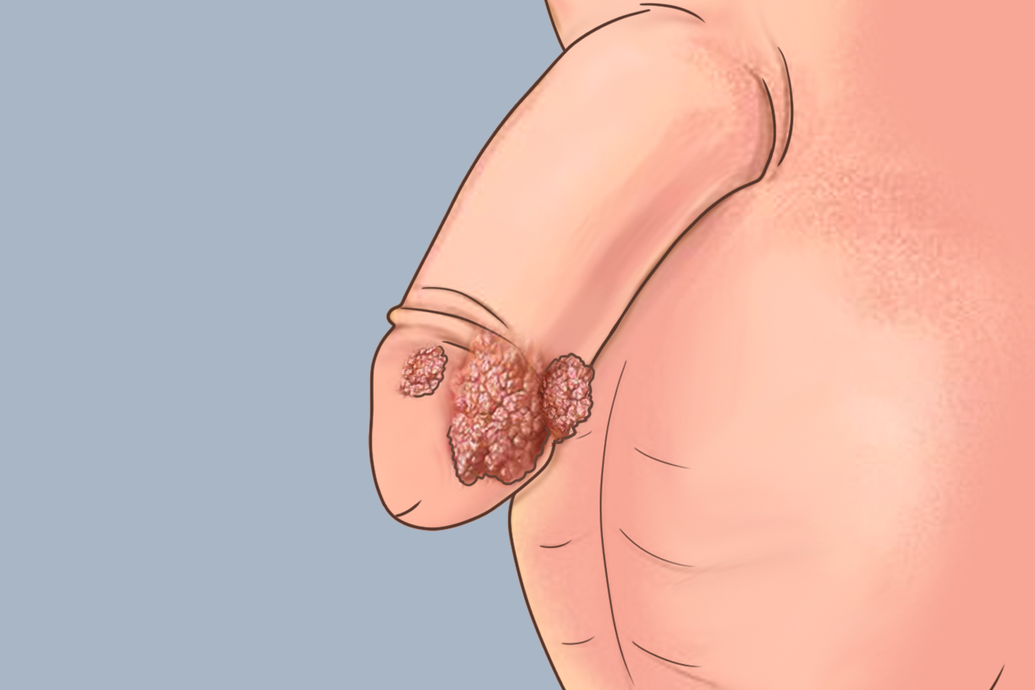 男性生殖器尖锐湿疣图